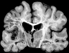 Cavitating infarcts within middle cerebral artery circulation